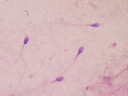 Deux spermogrammes côte à côte sur le bureau d'une clinique
